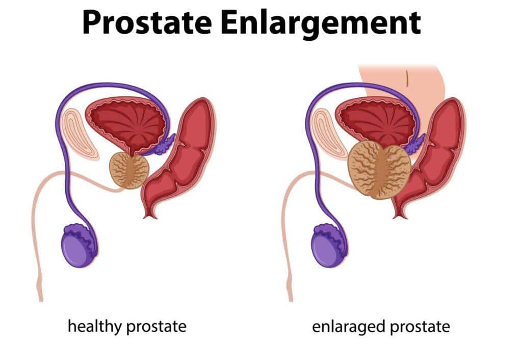 Prostat Biyopsisi