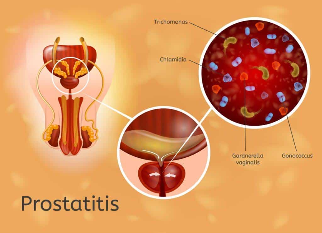 Prostat Biyopsisi