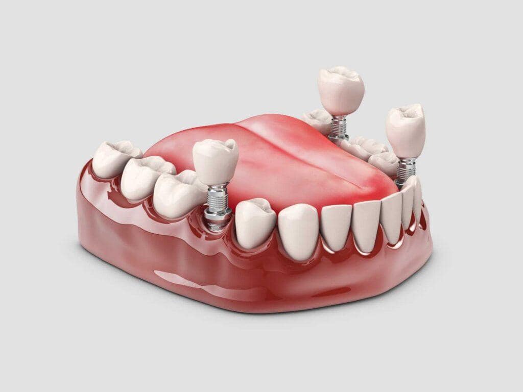 implant