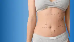 Karin Germe Ameliyatı Nedir