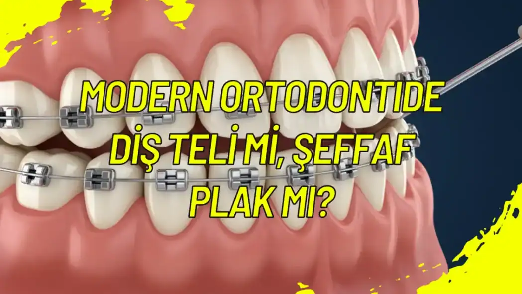 Modern Ortodontide Dİş Telİ